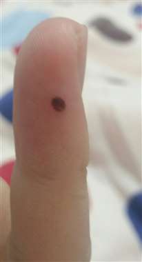 手指上有一个黑斑，是什么情况？