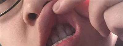 口腔上颚含牙囊肿手术，3.3*4.3.到现在已经1个月了。手术10天拆线的时候发现有个洞