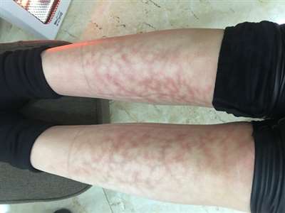 女，25岁，大概在半个多月前小腿出现红色经脉状的纹路，不疼不痒，有逐渐加深和蔓延的趋势，怎么回事？