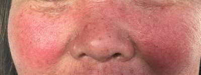 皮肤上有红点，会扩散，一见到阳光就会更严重，刚开始感觉是在皮肤底下，现在到皮肤表面了，有稍微的痒。