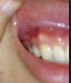 牙龈有白点是什么？
