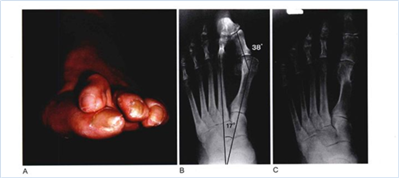 拇指外翻手术治疗有效吗,有什么副作用?会反复吗?