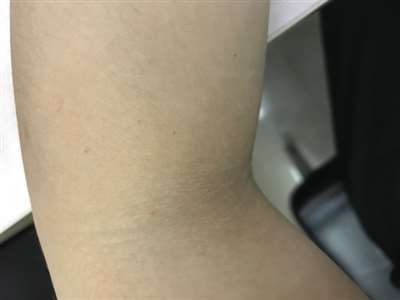 为什么手臂会长一点点细细的黑点，感觉像斑点。这是怎么回事