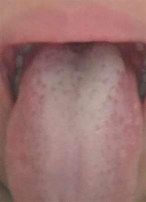 我舌头和嘴唇最近老是会干，这是艾滋病吗？急！