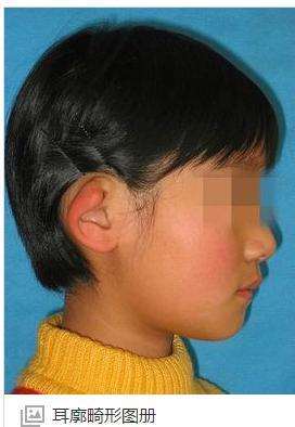 新生儿：两只耳朵的上耳廓都有部分弯曲，麻烦问一下怎么治疗？