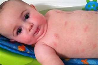 母乳喂养的宝宝得了湿疹什么情况？