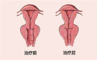 阴道紧缩术是怎么进行的？