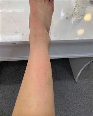 脚上荨麻疹风团需要多长时间恢复？