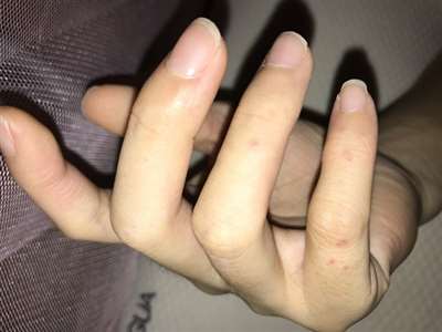 我手指上长的红点是什么