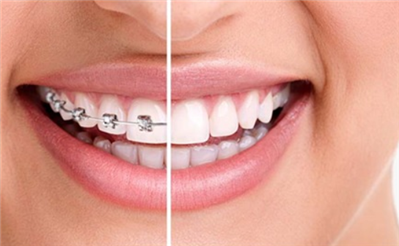 牙齿矫正选哪种牙套比较好？