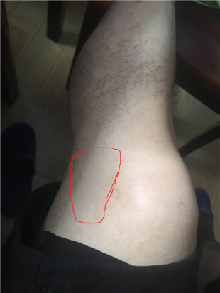 这段时间左脚膝盖左侧边一直酸痛，不是很明显，以前也有过几次