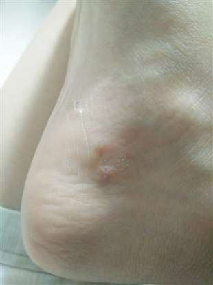 这是湿疹吗，只长在右脚，一片片的小水泡，前期发红、痒，往后就变成白色，最后变硬脱皮，该抹什么药膏呢