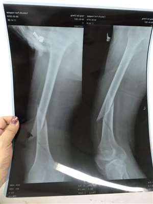 膝盖以上大胯以下骨折叫什么骨折？