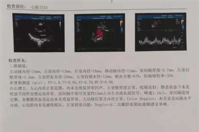 9个月宝宝心脏瓣膜关闭不全，导致右心室增大