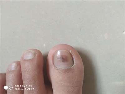 脚指甲盖里有像血块一样的，不会痛，是不是什么真菌感染