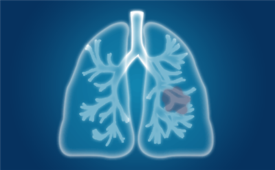 肺炎的症状特征是怎样的呢？