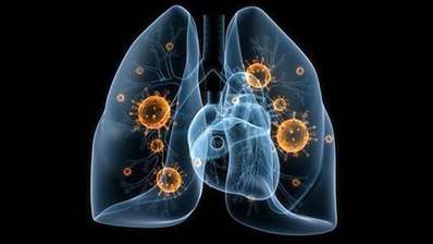 肺炎的症状特征是怎样的呢？