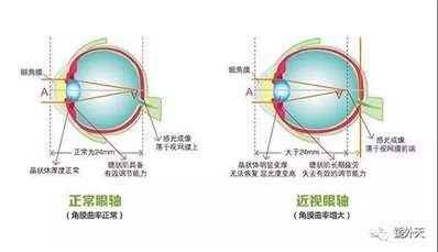 眼球眼轴对孩子的视力影响大吗？