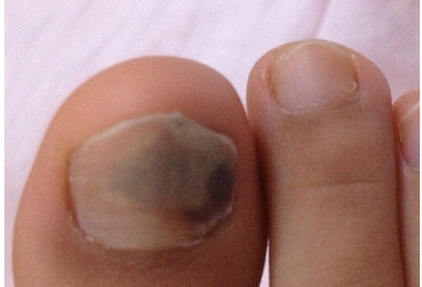 这是灰指甲吗？几个月前突然一个脚趾甲变黑紫，只有一半是，但是长了几个月就这样了，是灰指甲吗？