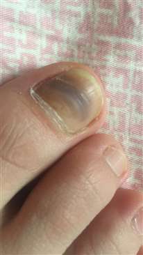 这是灰指甲吗？几个月前突然一个脚趾甲变黑紫，只有一半是，但是长了几个月就这样了，是灰指甲吗？