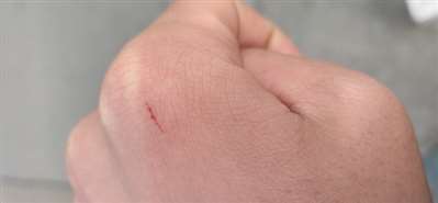 请问被猫卡里的猫用爪子刮伤了，要不要打疫苗？